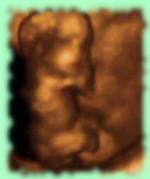 1st trimester 3 dimensional ultra sound